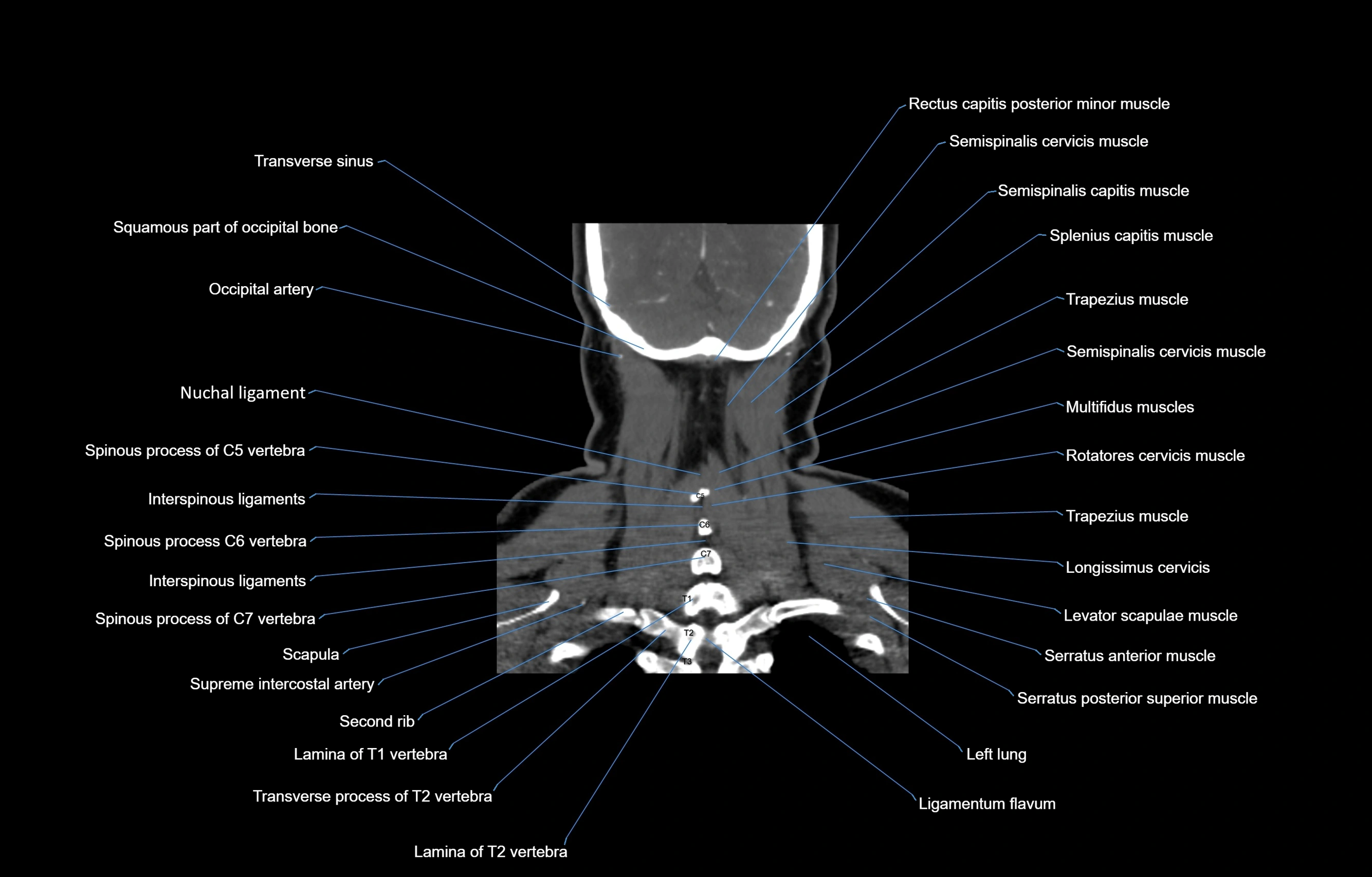 CT Neck coronal  cross sectional anatomy labelled 3D  radiology  image-00055.webp